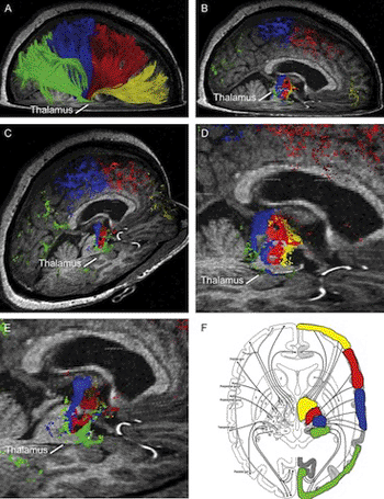 Image: High definition fiber tracking, or HDFT, images of the brain’s fiber network that accurately reflect brain anatomy observed in surgical and laboratory studies (Photo courtesy of the University of Pittsburgh School of Medicine). 